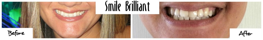 Smile Brilliant results